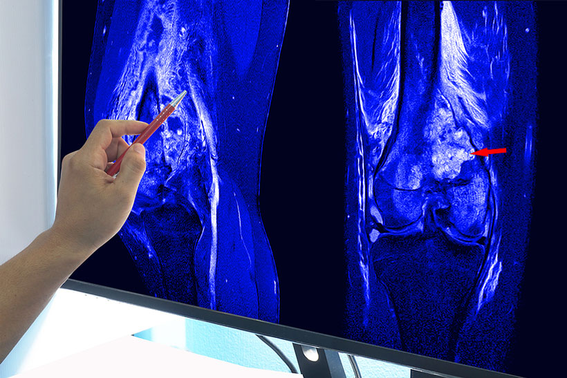 Dr. Johannes Gründler erklärt an einer MRT Aufnahme des Kniegelenks dem Patienten die Auswirkung eines Knochenmarködems